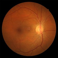 Hypertensive retinopathy shown by fluorescein angiography